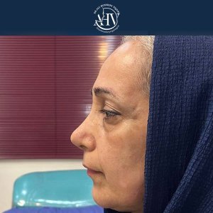 جراحی-بینی-20