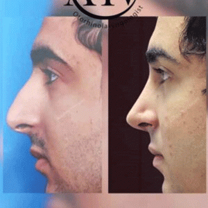 جراحی-بینی-3