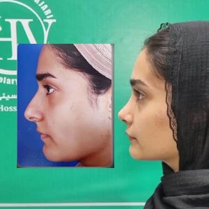 1_rhinoplasty45