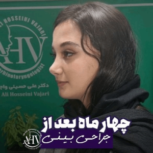 rhinoplasty-100