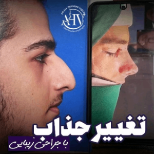 rhinoplasty-102