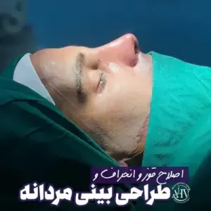 rhinoplasty-106