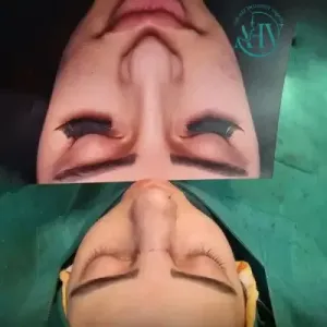 rhinoplasty-107