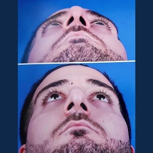 rhinoplasty-51