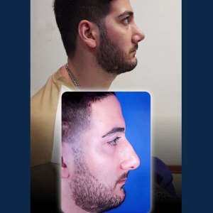 rhinoplasty-52