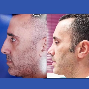 rhinoplasty-53