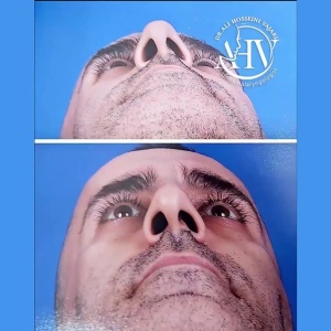 rhinoplasty-54