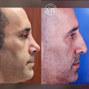 rhinoplasty-55