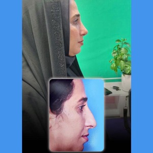 rhinoplasty-57