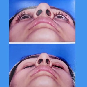 rhinoplasty-58