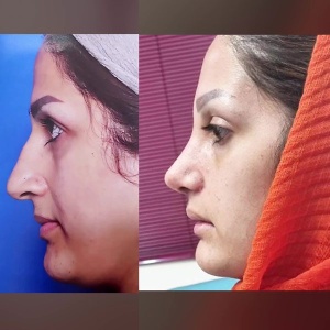 rhinoplasty-59