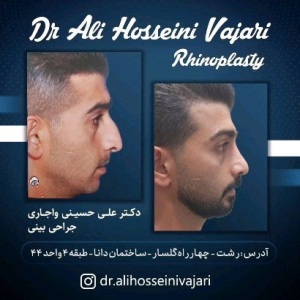 rhinoplasty-60