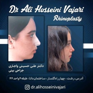 rhinoplasty-61