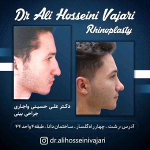 rhinoplasty-62