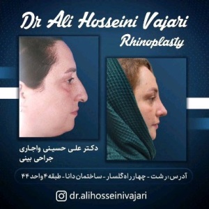 rhinoplasty-63