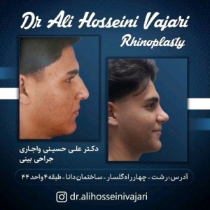 rhinoplasty-64