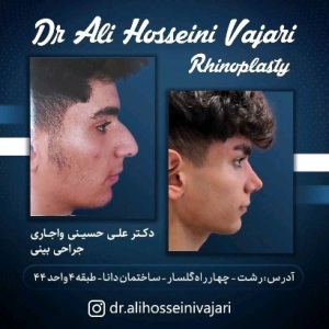 rhinoplasty-65