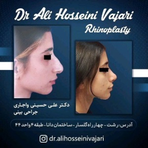 rhinoplasty-66