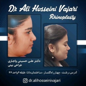 rhinoplasty-67