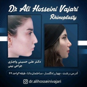 rhinoplasty-68