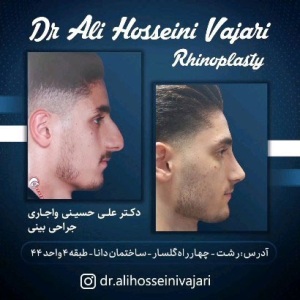 rhinoplasty-69