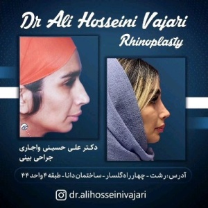 rhinoplasty-70