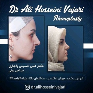 rhinoplasty-71