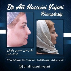 rhinoplasty-72
