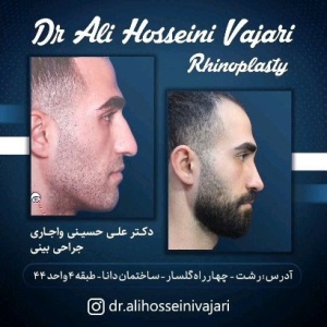 rhinoplasty-73