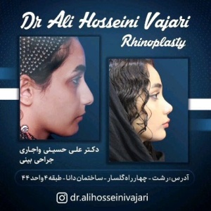 rhinoplasty-74