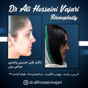 rhinoplasty-75