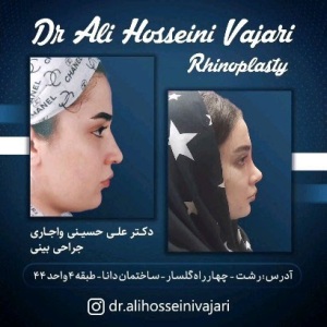 rhinoplasty-76