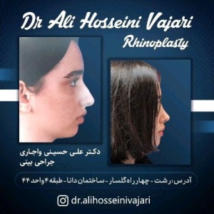 rhinoplasty-77