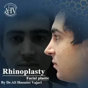 rhinoplasty-79