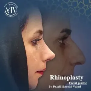 rhinoplasty-80