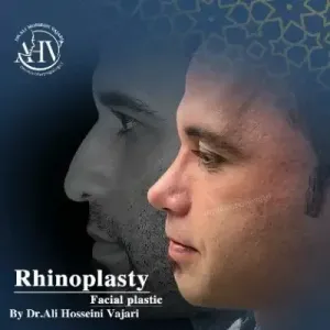 rhinoplasty-81