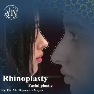 rhinoplasty-82