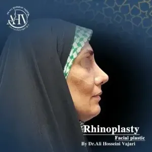 rhinoplasty-83