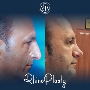 rhinoplasty-84