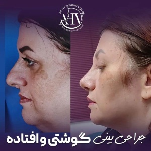 rhinoplasty-85