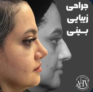 rhinoplasty-87