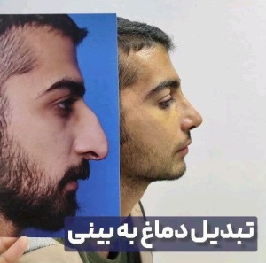 rhinoplasty-88