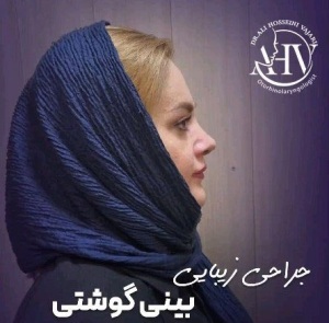 rhinoplasty-89