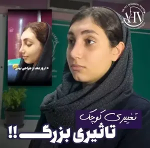 rhinoplasty-90