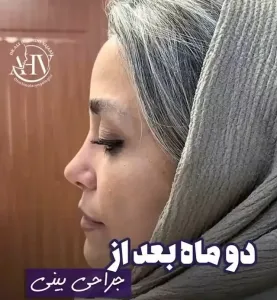 rhinoplasty-92