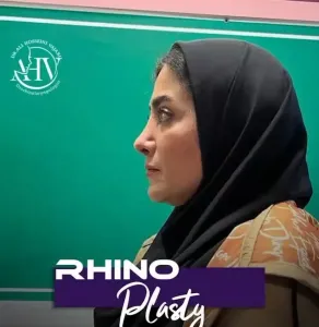 rhinoplasty-93