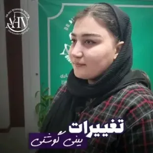rhinoplasty-95