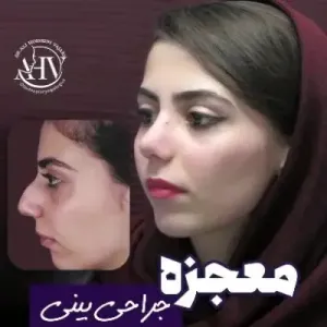 rhinoplasty-96