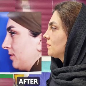 rhinoplasty.39