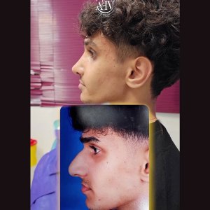rhinoplasty.40